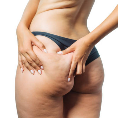 Silhouette Pro + : Pourquoi la cellulite persiste malgré le sport et une bonne alimentation ?